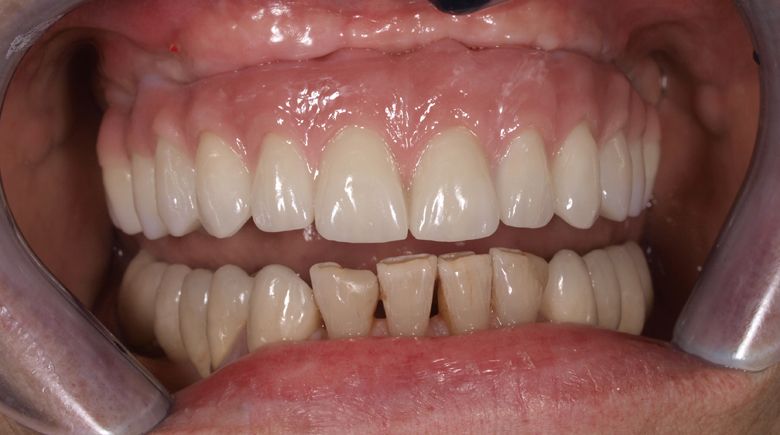 ესთეტიური გამოსახულება მოუხსნელი კონსტრუკციის ზედა ყბაზე 