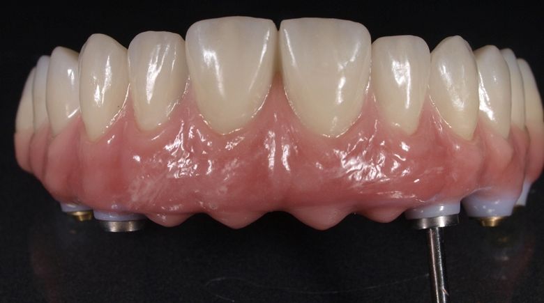 ესთეტიკური პროთეზი ზედა ყბაზე